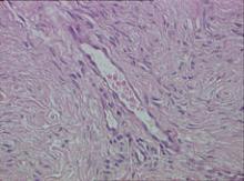 Neoplastic spindle-shaped cells and a thick-walled blood vessel (H&E, original magnification ×40).