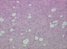 Neoplastic neuroid tissue that occupied the dermis and hypodermis (H&E, original magnification ×20).