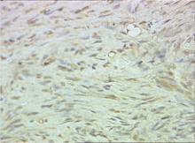 Immunohistochemical staining with S-100 protein highlighted the localization of neuroid tissues (original magnification ×40).