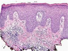 Mixed dermal inflammation with ill-formed, noncaseating granulomas (H&E, original magnification ×100).