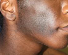 Hyperpigmented hairy patch on the right cheek (Becker nevus) in a patient with hemimaxillary enlargement, asymmetry of the face, tooth abnormalities, and skin findings (HATS syndrome).