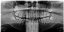 Dental radiograph demonstrated hyperplasia of the right maxillary alveolus and basal bone area with 2 missing permanent teeth (fourth and fifth premolars).