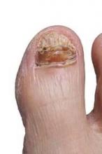 Patients have reported few side effects associated with powerful new topical therapies for onychomycosis.