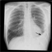 Sinusitis and pneumonia incidences in children under 5 were drastically reduced after introduction of PCV7 and PCV13 vaccinations.