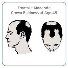 Specific patterns of baldness may indicate increased risk of aggressive prostate cancer.