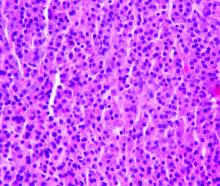 Multiple myeloma (which is diagnosed using several clinical criteria) is, histologically, a plasmacytoma.