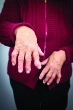 Hands of a woman with rheumatoid arthritis