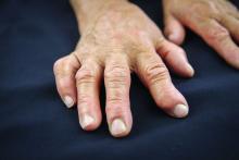 A photo a woman with rheumatoid arthritis' hands