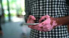 Hands of man with vitiligo using smartphone