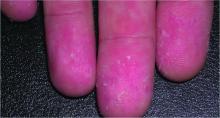 Blanchable macules and papules typically start on the face or trunk, 3-5 days after the febrile phase of Zika virus, and spread to the fingers and feet.