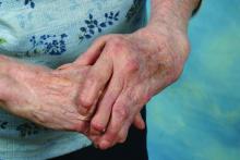 Rhumatoid arthritis hands with ulnar drift