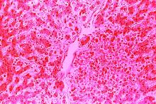 This hematoxylin eosin-stained photomicrograph depicts the cytoarchitectural changes found in a liver tissue specimen extracted from a dengue hemorrhagic fever patient.