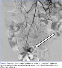 CT angiography demonstrating extravasation