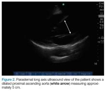 Dilated proximal ascending aorta measuring approximately 5 cm