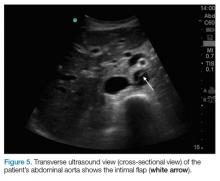 Transverse ultrasound view of the abdominal aorta