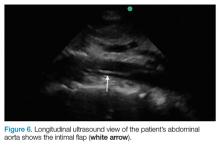 Longitudinal view of the abdominal aorta shows the intimal flap