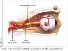 Illustration demonstrating facial, retinal, and carotid artery anastomosis