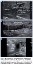 Long-axis view demonstrating a near complete tear of tendon with hematoma formation.