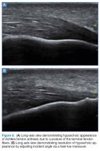 Long-axis view hypoechoic appearance of Achilles tendon and resolution of hypoechoic appearance. 