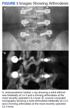 Images Showing Arthrodesis figure