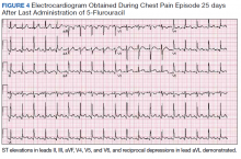 Electrocardiogram Obtained During Chest Pain Episode 25 days After Last Administration of 5-Flurouracil