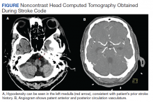 Noncontrast Head Computed Tomography Obtained During Stroke Code figure