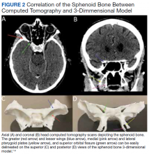 Correlation of the Sphenoid Bone Between Computed Tomography and 3-Dimmensional Model