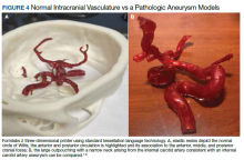 Normal Intracranial Vasculature vs a Pathologic Aneurysm Models