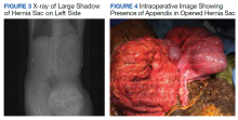 X-ray of Large Shadow of Hernia Sac on Left Side and Intraoperative Image Showing Presence of Appendix in Opened Hernia Sac