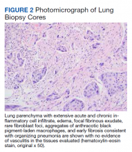 Photomicrograph of Lung Biopsy Cores