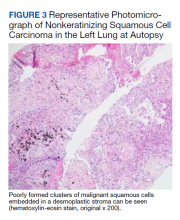 Representative Photomicrograph of Nonkeratinizing Squamous Cell Carcinoma in the Left Lung at Autopsy