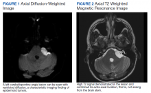 Axial Diffusion-Weighted Image and Axial T2 Weighted Magnetic Resonance Image