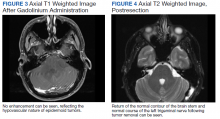 Axial T1 Weighted Image After Gadolinium Administration and Axial T2 Weighted Image, Postresection