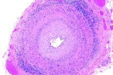 Histology of giant cell arteritis under a light microscope.