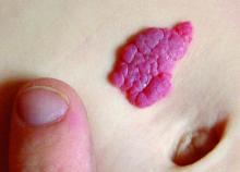 Hemangiomas usually appear as rubbery collections of blood cells after birth.