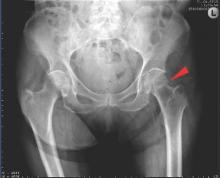 This is a medial fracture in a 92-year-old woman.