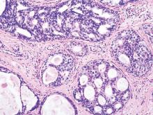 Histopathologic image from DCIS of breast. Hematoxylin-eosin stain.