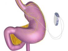 The device works by sending intermittent electrical pulses to the abdominal vagus nerve.