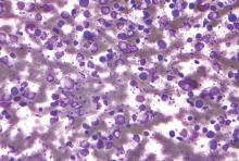 A micrograph of a diffuse large B cell lymphoma.