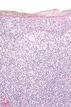 High-magnification micrograph of cutaneous T-cell lymphoma.