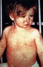 Measles cases have been reported in 14 states as of Jan. 29, the CDC said. 