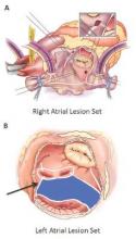 Illustration shows the standard right (A) and left (B) atrial lesion sets utilized for the Cox-Maze IV procedure.