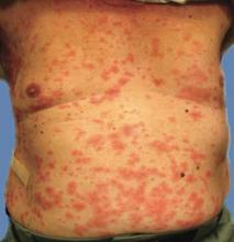 Figure 1. Numerous nonfollicular-based pustules on diffuse erythematous patches. 