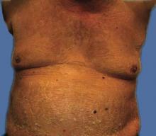 Figure 4. Generalized desquamation following resolution of acute generalized exanthematous pustulosis. 
