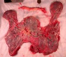 In this irregular placenta, there is no consistent pattern to the shape but the placenta has grown where it could, creating the \"best\" placenta possible for the fetus.