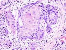 This histopathologic image shows well-differentiated squamous cell carcinoma in an excisional biopsy specimen.