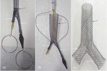 Use of personalized Y-en-Y stents aided in treatment of airway fistulas.