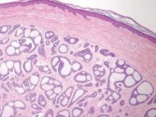 Figure 3. Striking cribriform architecture of cutaneous adenoid cystic carcinoma (H&E, original magnification ×40). The tumor is well circumscribed and consists of multiple cystic spaces lined by flattened to cuboidal basaloid epithelium. 