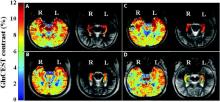 In coronal sections from four patients with drug-resistant temporal lobe epilepsy (TLE), glutamate imaging signal increases are seen in the right hippocampus in right TLE in A and B images and left hippocampus in left TLE in C and D images.