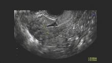 Hysterosonogram evaluation of a uterine isthmocele.